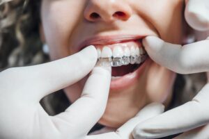 Doctor putting a clear dental aligner to the patient woman TranscenDental Smiles is a trusted ORTHODONTIC TREATMENT provider